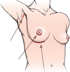 Platzierung der Schnitte (Incisionsbestimmung) bei einer Brustvergößerung
