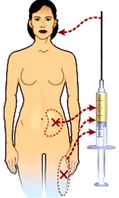 Fettinjektionen für eine Lippenkorrektur