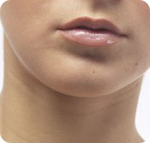 Lippenkorrektur mit Lippenimplantaten