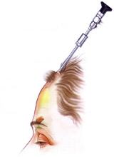 Operationsverlauf beim endoskopischen Stirnlifting