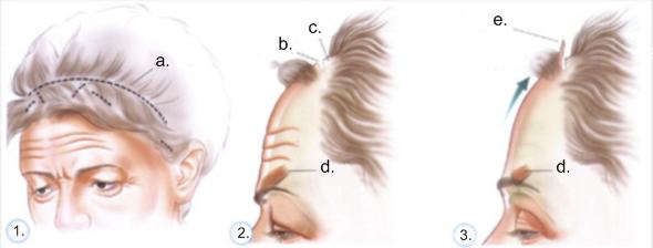 Operationsverlauf beim traditionellen (offenen) Stirnlifting